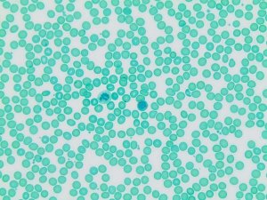 -Naphthyl Butyrate Esterase, Lymphocyte 