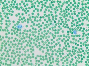 Acid Phosphatase, Lymphocyte 