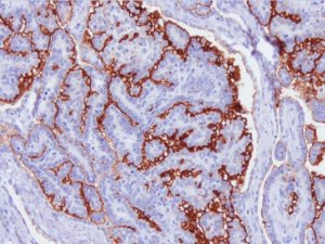 Anti-Mucin-16 (CA-125) Antibody, clone 5E11 MABC1608-25UG